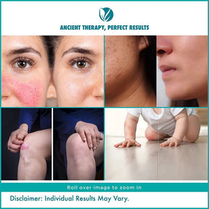 বারফানি একজিমা রিলিফ ক্রিম-প্রাকৃতিক (কোন স্টেরয়েড নেই) একজিমা ডার্মাটাইটিস দাদ ছত্রাকের সংক্রমণ ত্বকের ফুসকুড়ি চুলকানি ডার্ক স্পট রিমুভার প্যাক অফ 4(20gx4)