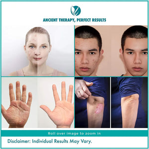 বারফানি একজিমা রিলিফ ক্রিম-প্রাকৃতিক (কোন স্টেরয়েড নেই) একজিমা ডার্মাটাইটিস দাদ ছত্রাকের সংক্রমণ ত্বকের ফুসকুড়ি চুলকানি ডার্ক স্পট রিমুভার প্যাক অফ 4(20gx4)